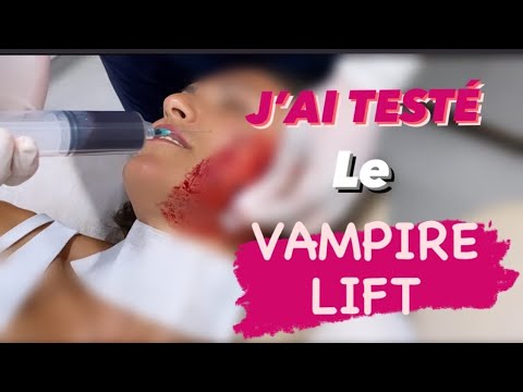 Vidéo: Personnes Diagnostiquées Séropositives Après «soin Du Visage Vampire»