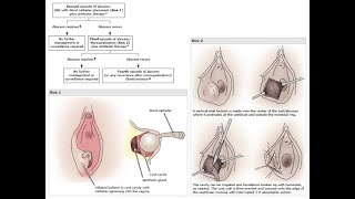 Bartholin glands, Bartholin’s Cyst, Bartholin’s Abscess, Bartholin’s Gland Carcinoma