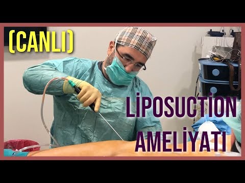 Liposuction Ameliyatı (Canlı)👍😷