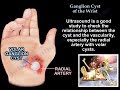 Ganglion Cyst Of The Wrist - Everything You Need To Know - Dr. Nabil Ebraheim