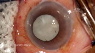 Posterior Capsular (PC)  tear during IOL Implantation