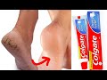 REMOVE CRACKED HEELS REMEDY | CRACKED HEELS HOME REMEDY