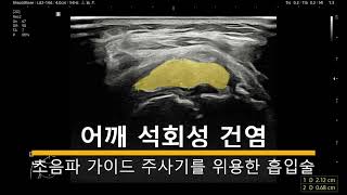 어깨 통증 어깨 석회 치료 주사기로 간단하게 해결하는 방법