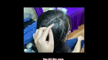 Xăm tóc thưa đỉnh đầu cho nữ, cận cảnh trước và sau khi hoàn thành - TítMi