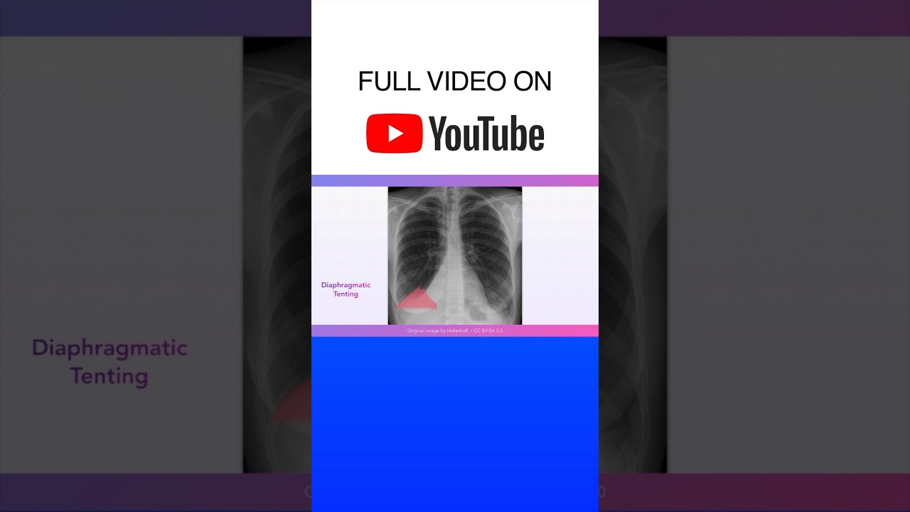 Atelectasis Chest X-rays
