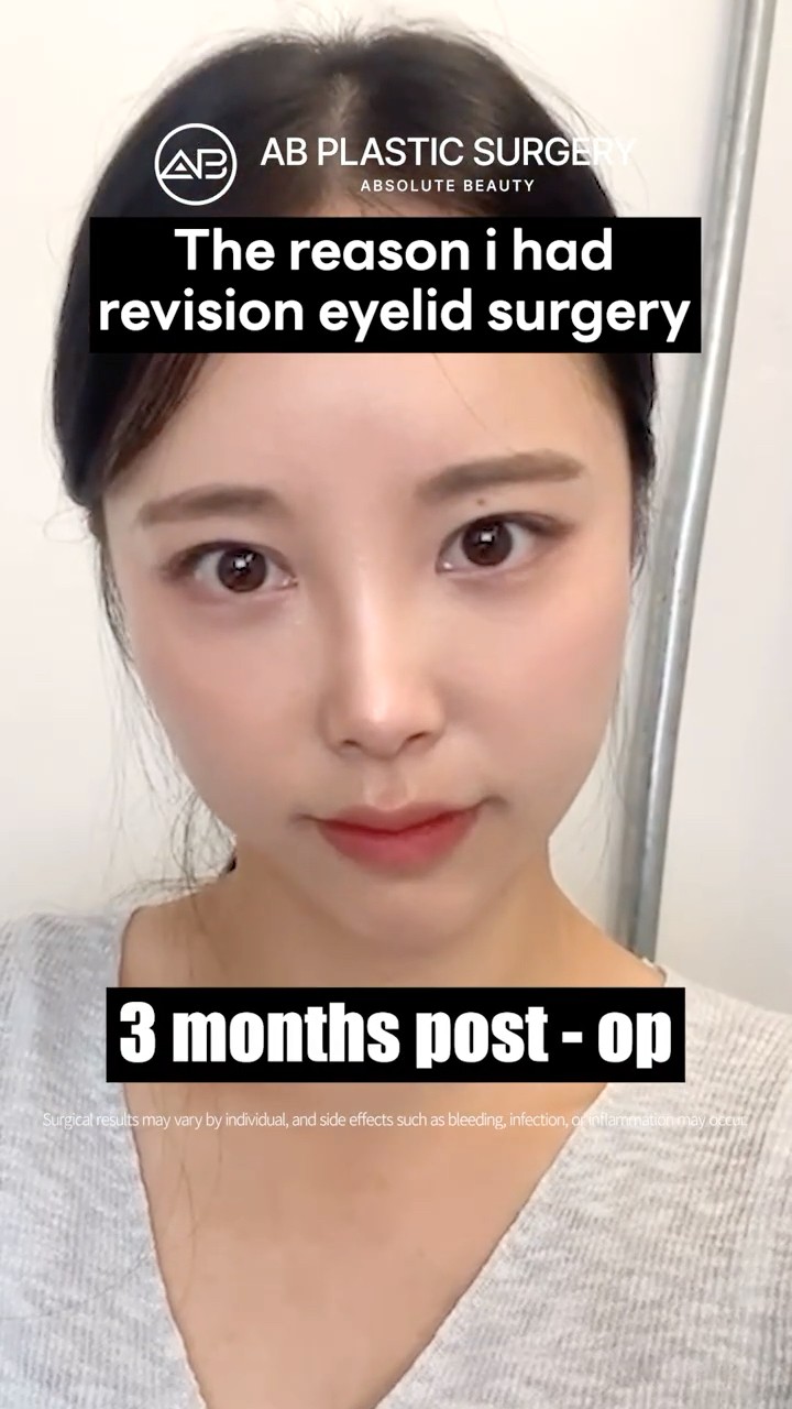 Ptosis Correction Changed Her Look ✨ #Shorts