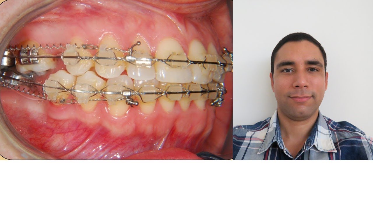 Hablemos de Ortodoncia! Caso Clinico 12:  Cerrando espacios con resorte de Niti