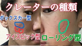 ニキビ跡 クレーターの種類と自力で治す方法まとめ アイスピック型 ボックスカー型 ローリング型 Youtube