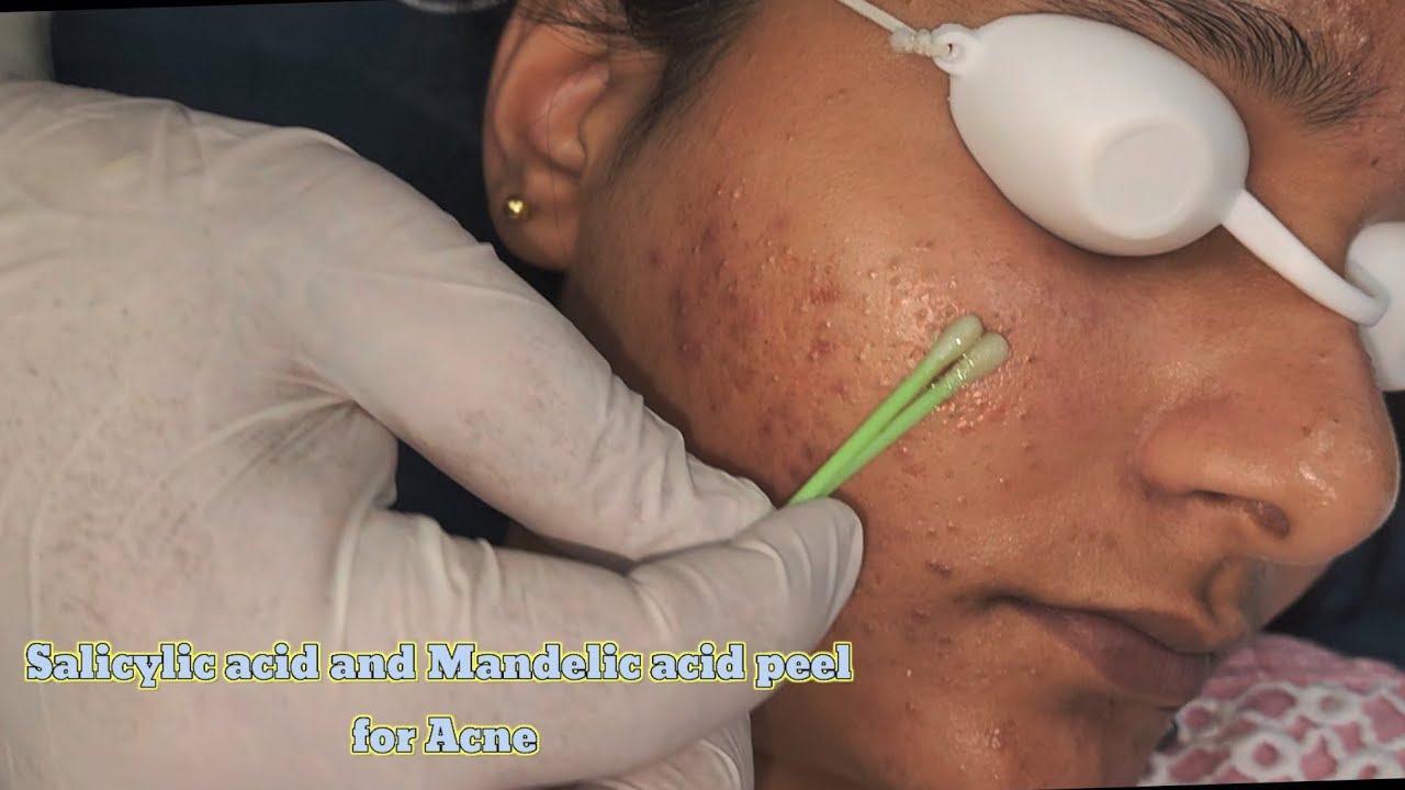 Mandelic & Salicylic Acid peel for Acne 