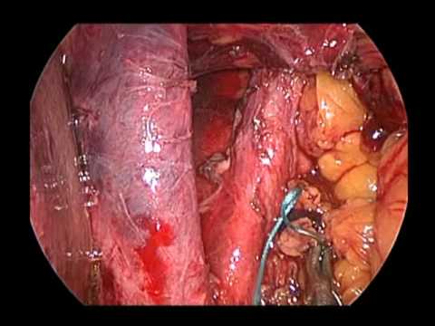 Laparoscopic Sleeve Gastrectomy & Paraesophageal Hernia Repair