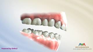Famous Deepbite Treatment by Reverse Curve of Spee Arch W Wealth