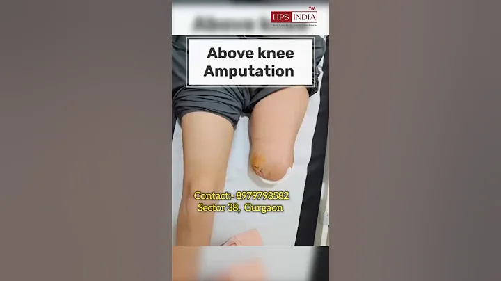 Above knee Amputation solution | Automatic | Nakli ghutna #ossur #artificialleg