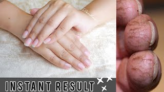 How to get rid of Cracked, Dry, Peeled fingers|| Overnight Healing Remedy Must try! screenshot 1