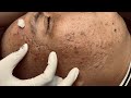 Relaxing acne treatment 61 