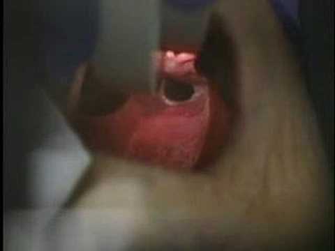Laryngoscopic Trachea بمقابلہ Esophagus
