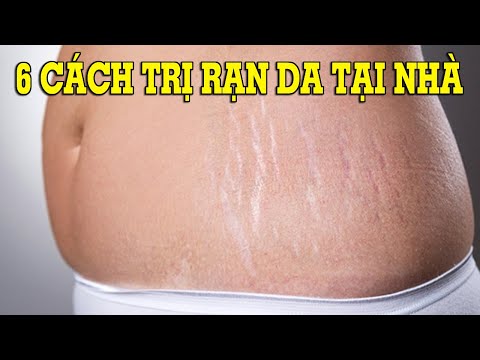 Video: 3 cách để thoát khỏi vết rạn da ở lưng