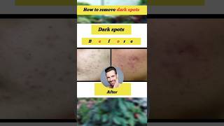 How to remove dark spots | beauty shorts
