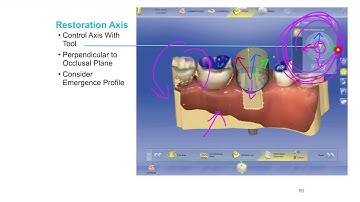 CEREC TiBase Lecture Series Lesson 06