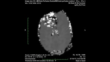 Mri Brain Perfusion Routine perfusion