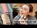 HOW TO GET RID OF KP ON ARMS AND LEGS | KERATOSIS PILARIS