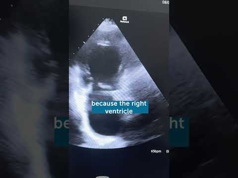 Image of Imaging an Inferior Myocardial Infarction