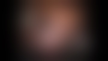 Robotic Extended Pelvic Lymph Node Dissection in Cervical Cancer