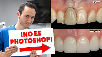 ¿Cómo pueden volver a crecer las encías entre los dientes de forma natural?