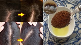 علاج لقشرة الشعر مجرب و هي وصفة فعالة جدا تخلصك من القشرة و الشعر الدهني نهائيا من اول استعمال ?
