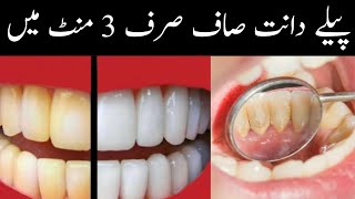 Teeth Whitening At Home In 3 Minutes || How To Whiten Your Yellow Teeth Naturally || 100% Effective