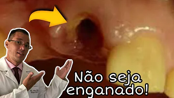 O que fazer quando o dente quebra um pedaço?