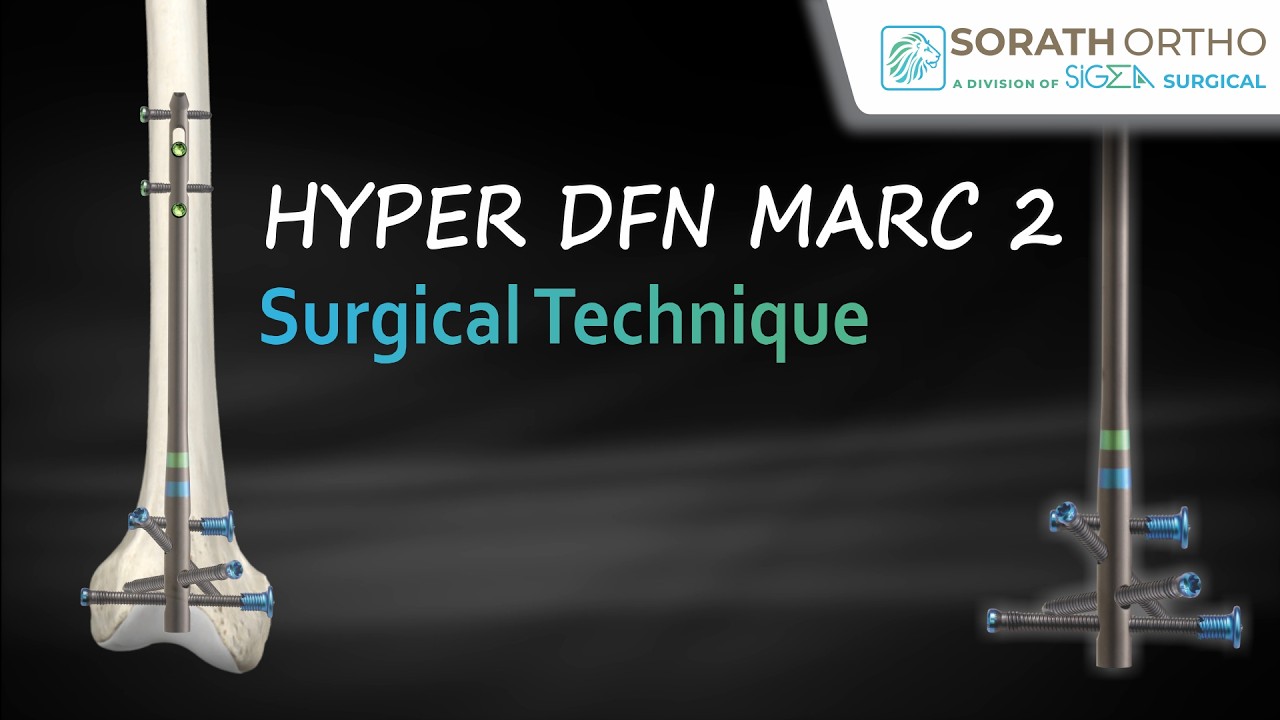 Hyper DFN Marc2 Surgical Technique