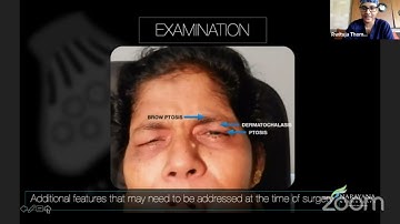 AIOC2021-FP1313-Dr Rwituja Thomas-Orbicularis Myectomy for Refractory Essential Blepharospasm