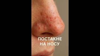 Постакне на носу #shorts
