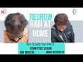 Hair growth with biopeptides results before after  hair fall treatment at home with biopeptides