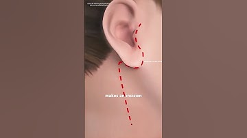 Parotidectomy 3D animation #drone #theflash #space #automobile