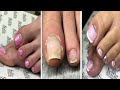 Most Amazing Ugly Toenails Transformation 2020 Awesome Pedicure Tutorial #17