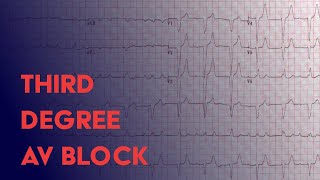 Third Degree (Complete) Heart Block -  EKG (ECG) Interpretation