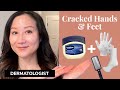 Heal Dry Cracked Hands Feet With This Quick Dermatologist Tip Heal Dry Cracked Hands Feet With This Quick Dermatologist Tip
