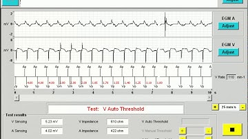 Interrogating a Microport pacemaker | Smart Check