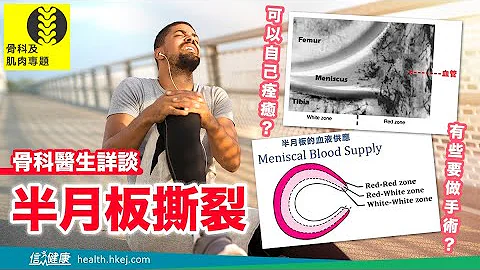 【骨科專家】半月板撕裂  可以自行康復嗎？ - 天天要聞
