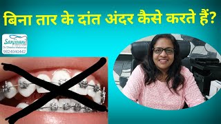 Is aligners better than braces?||बिना तार के दांत अंदर कैसे करे?||टेढ़े मेढ़े दांतको सीधा कैसे करे?