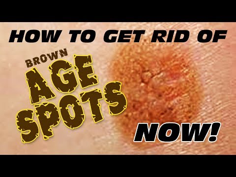 How to Get Rid of Brown Age Spots