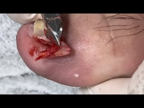 Ep_6579 Big ingrown toenail removal 👣 หนูดูสิ..ทำไมมันถึงออกยาก 😄 (clip from Thailand)