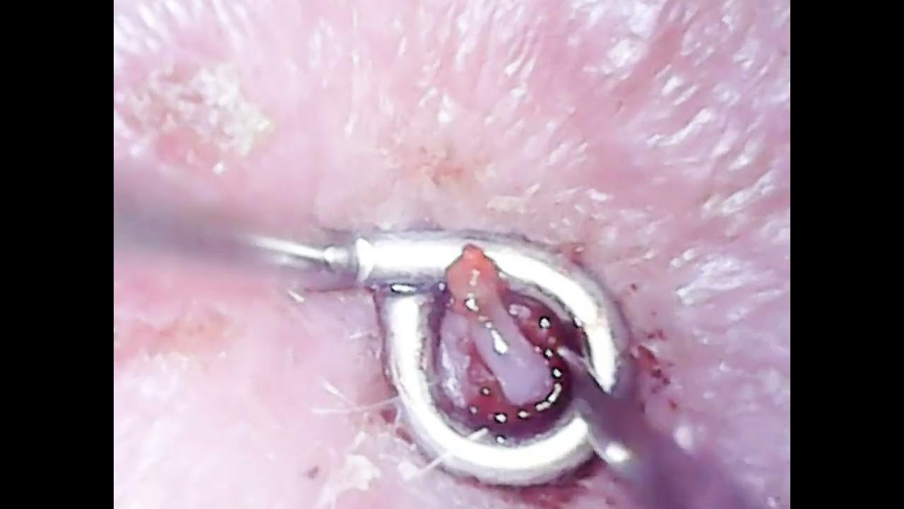sebaceous-filaments-infected-hair-follicles-july-6-video-youtube