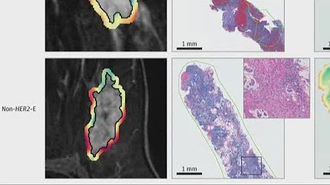 Local researchers use artificial intelligence to predict cancer treatment outcomes