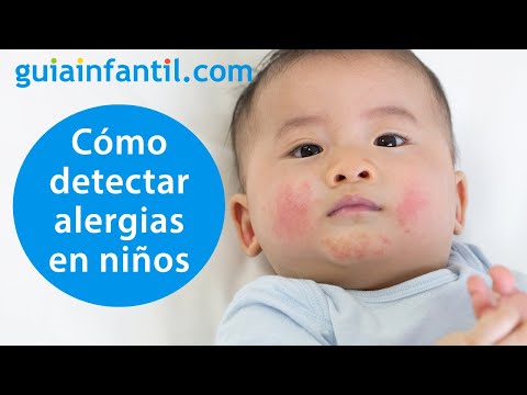 Cómo reconocer una reacción alérgica en un niño y cuándo llevarle a urgencias | Alergias infantiles