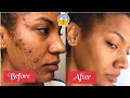 How I Beat Cystic Acne | Full Skin Care Routine | Oily Acne Prone Skin | Pgeeeeee