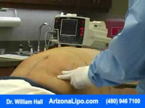 Liposuction Procedure with Dr. William Hall - Abdo...