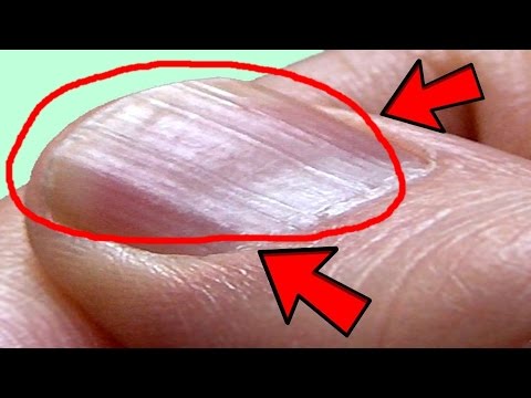 What Causes Ridges in Finger and Toenails