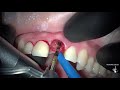 Как удаляют и имплантируют зубы в один визит.